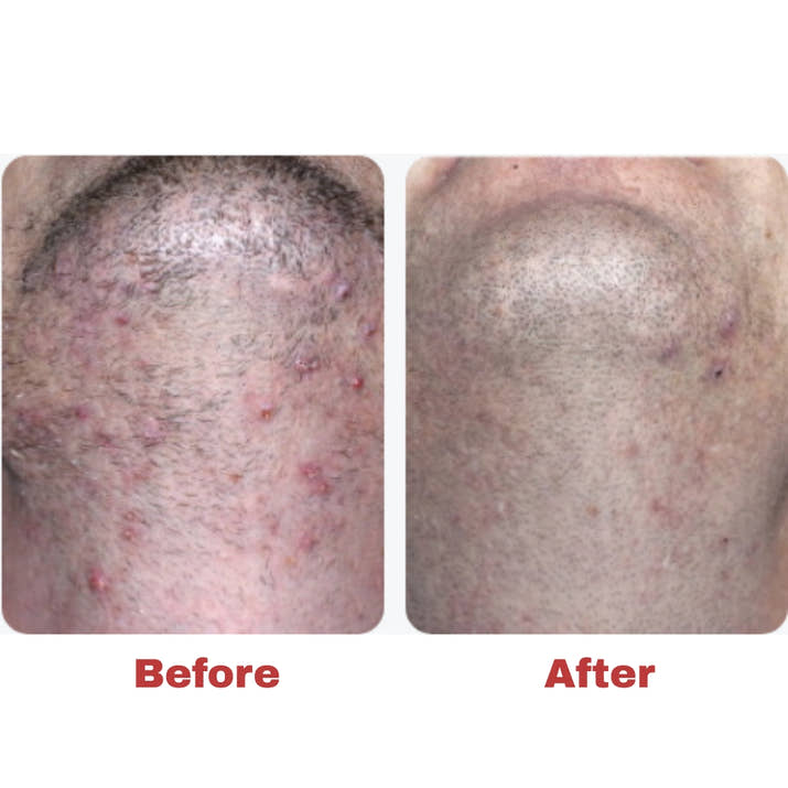 Ingrown Hair Treatment - Fast-Acting Formula with AHAs for Bikini, Underarm, Legs