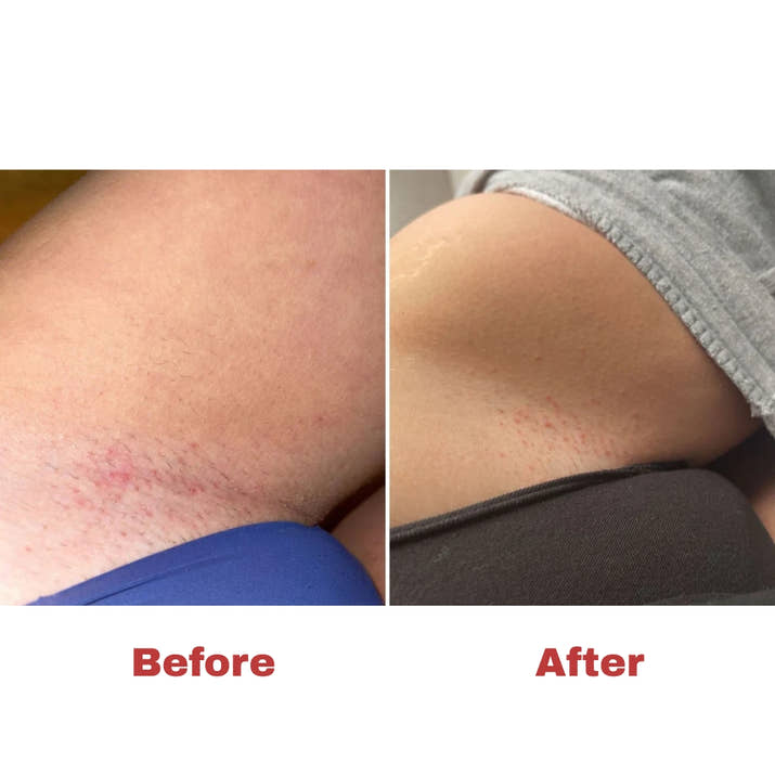 Ingrown Hair Treatment - Fast-Acting Formula with AHAs for Bikini, Underarm, Legs