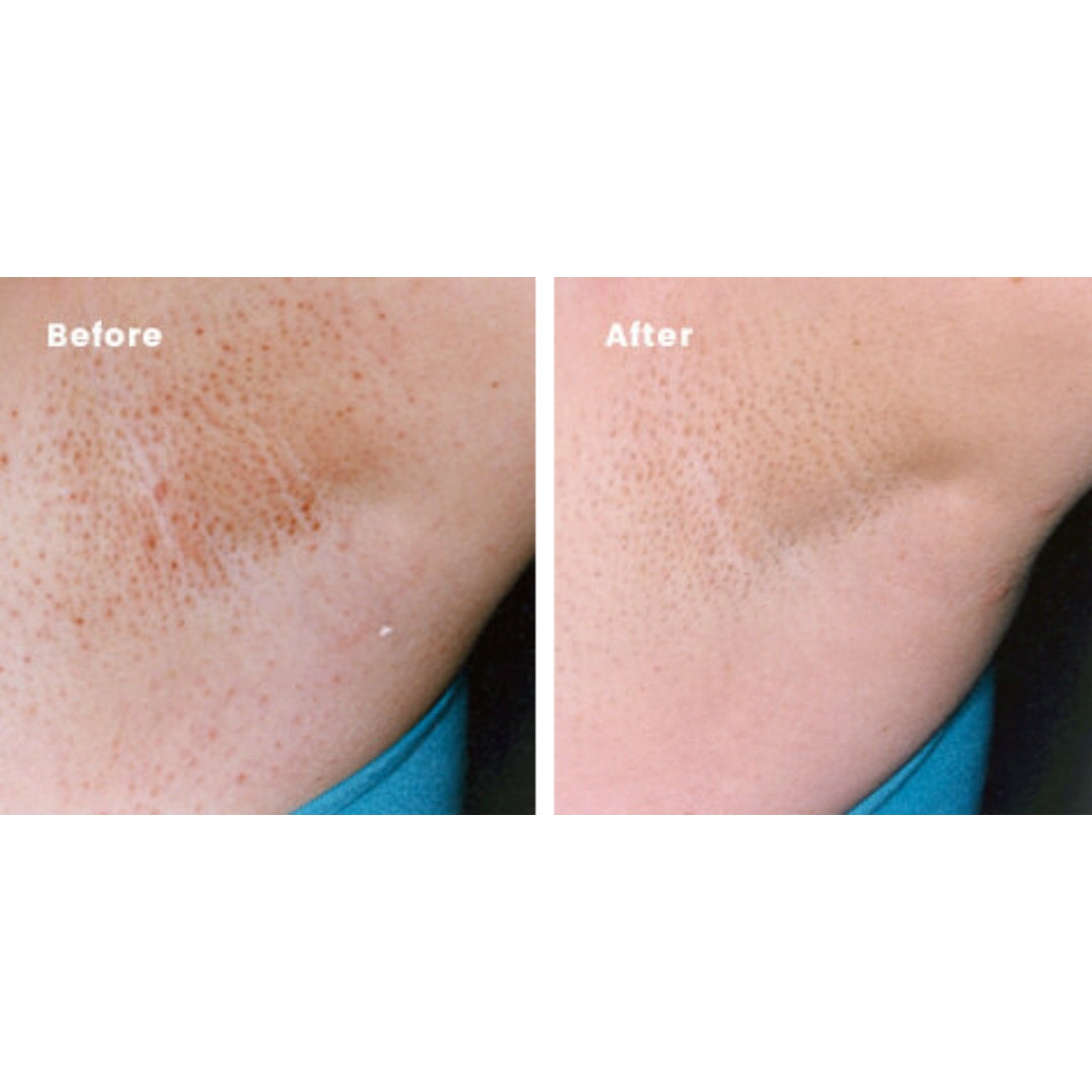 Ingrown Hair Treatment - Fast-Acting Formula with AHAs for Bikini, Underarm, Legs