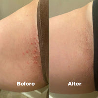 Ingrown Hair Treatment - Fast-Acting Formula with AHAs for Bikini, Underarm, Legs